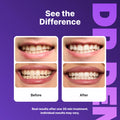 Elevate Your Smile with DRDENT Purple Teeth Whitening Strips - 7 or 21 Sessions of Gentle, Peroxide-Free Whitening for a Radiant Look