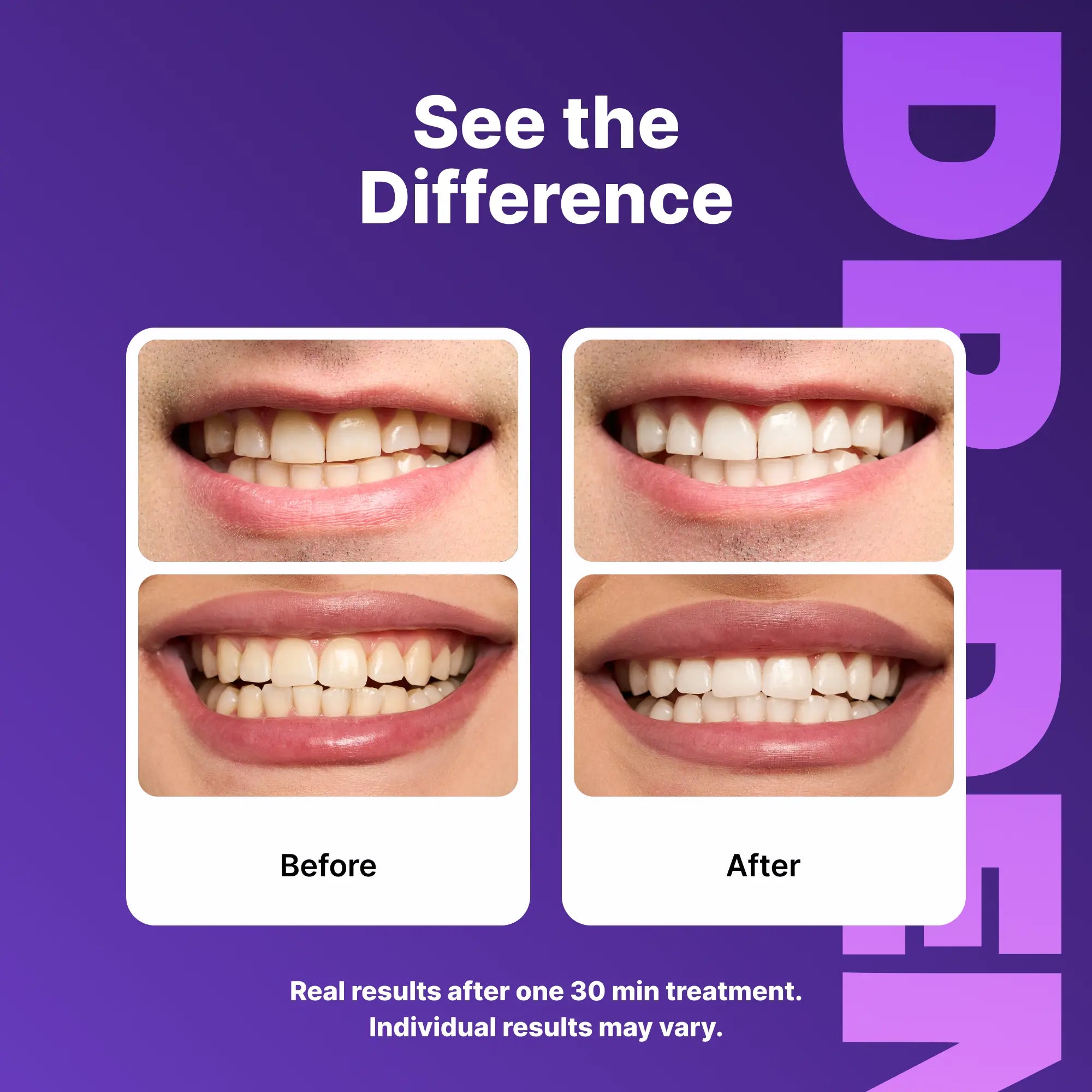 Elevate Your Smile with DRDENT Purple Teeth Whitening Strips - 7 or 21 Sessions of Gentle, Peroxide-Free Whitening for a Radiant Look